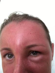 Day 3 of my sunburn experience. when my left eye was finally beginning to open up again!
